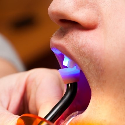 Close up of man getting dental bonding on tooth hardened with curing light