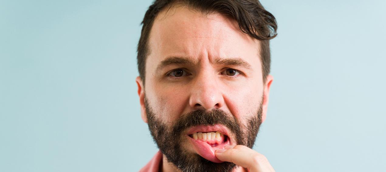 Man in pink shirt pulling down lower lip to reveal gum disease
