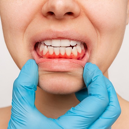 Gloved hand pulling down someone’s lower lip to reveal darkened gums