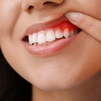 Nose-to-chin closeup of woman pulling back upper lip with single finger to reveal dark red gums
