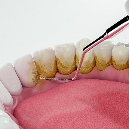 Rendering of deep cleaning of gumline with white background