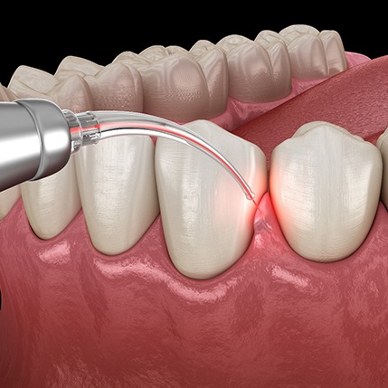 Rendering of laser shaping gums with black background
