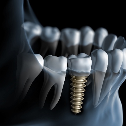 Illustrated X ray of person with dental implant replacing a missing lower tooth