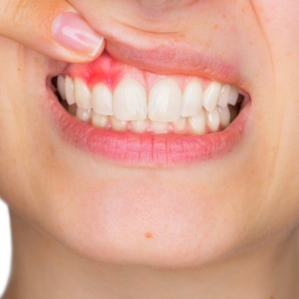 Close up of person pointing to red spot in their gums