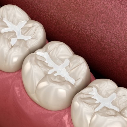 Close up of illustrated teeth with tooth colored fillings