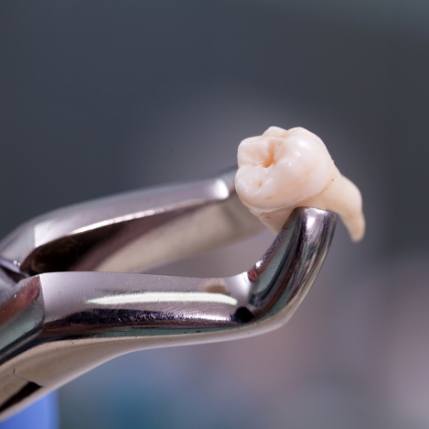 Dental forceps holding a tooth after tooth extractions in Marion