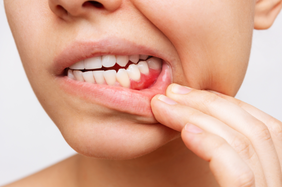 Woman pulling lip down to show reddened gums